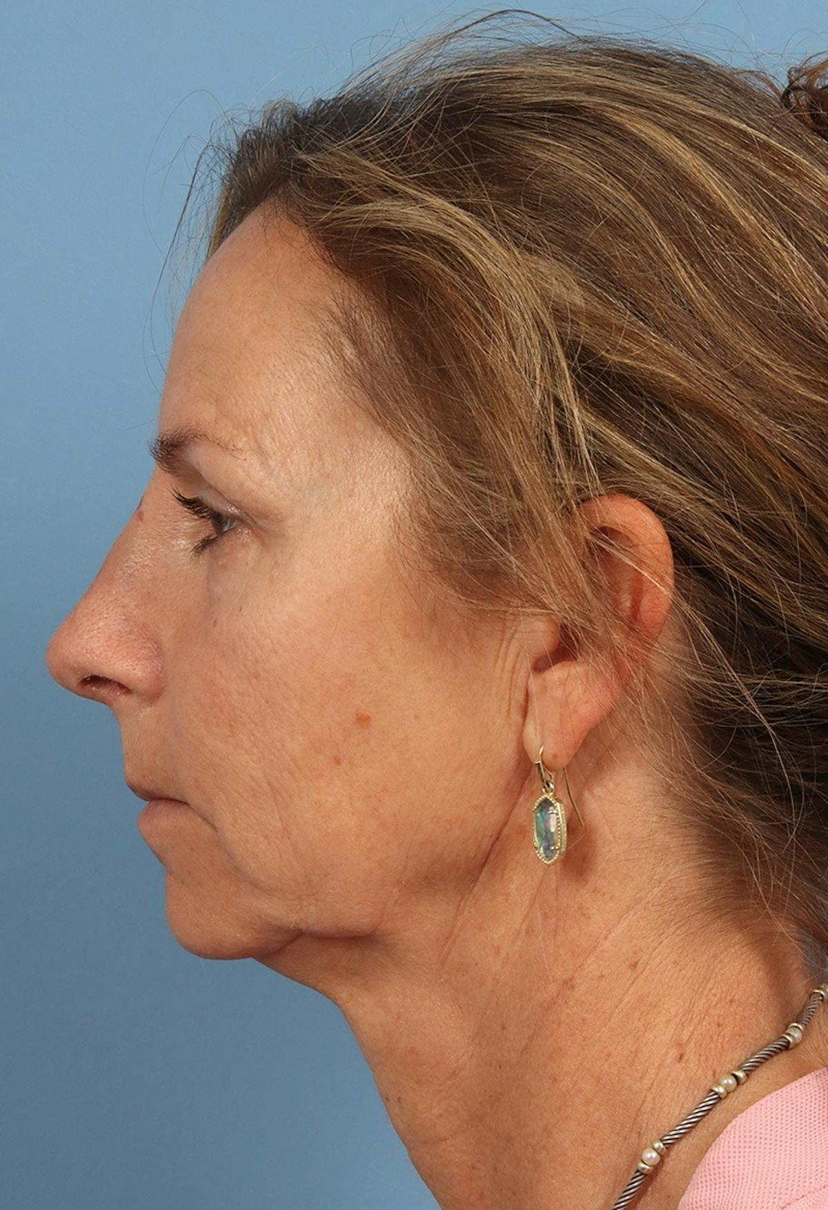 Basu Plastic Surgery rhinoplasty after — Houston, TX