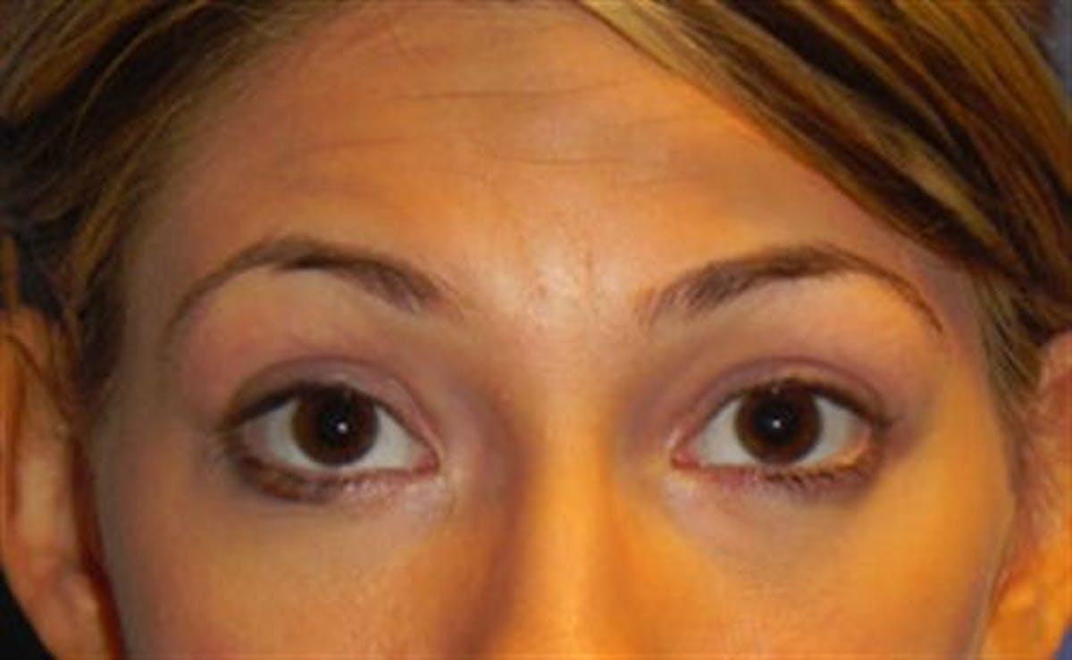Basu Plastic Surgery blepharoplasty after — Houston, TX