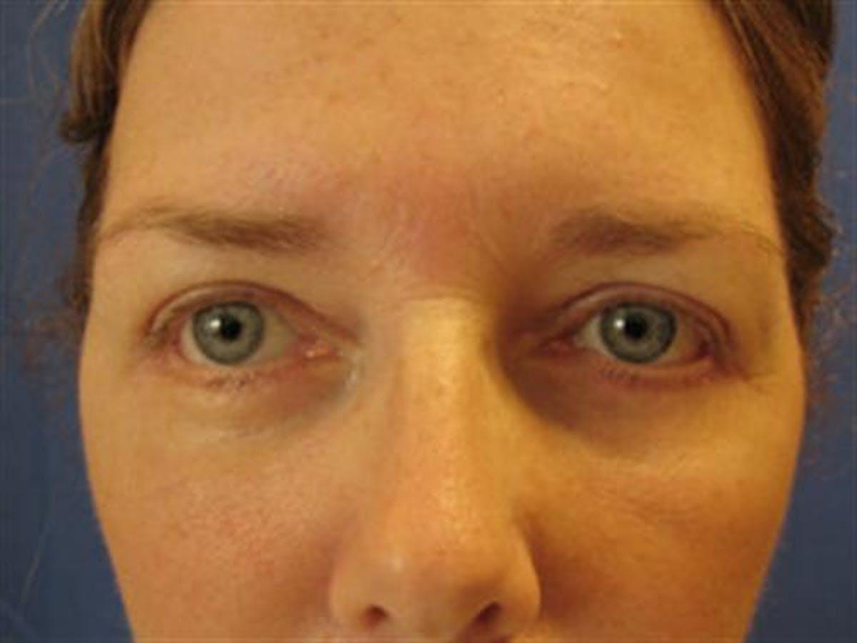 Basu Plastic Surgery blepharoplasty after — Houston, TX