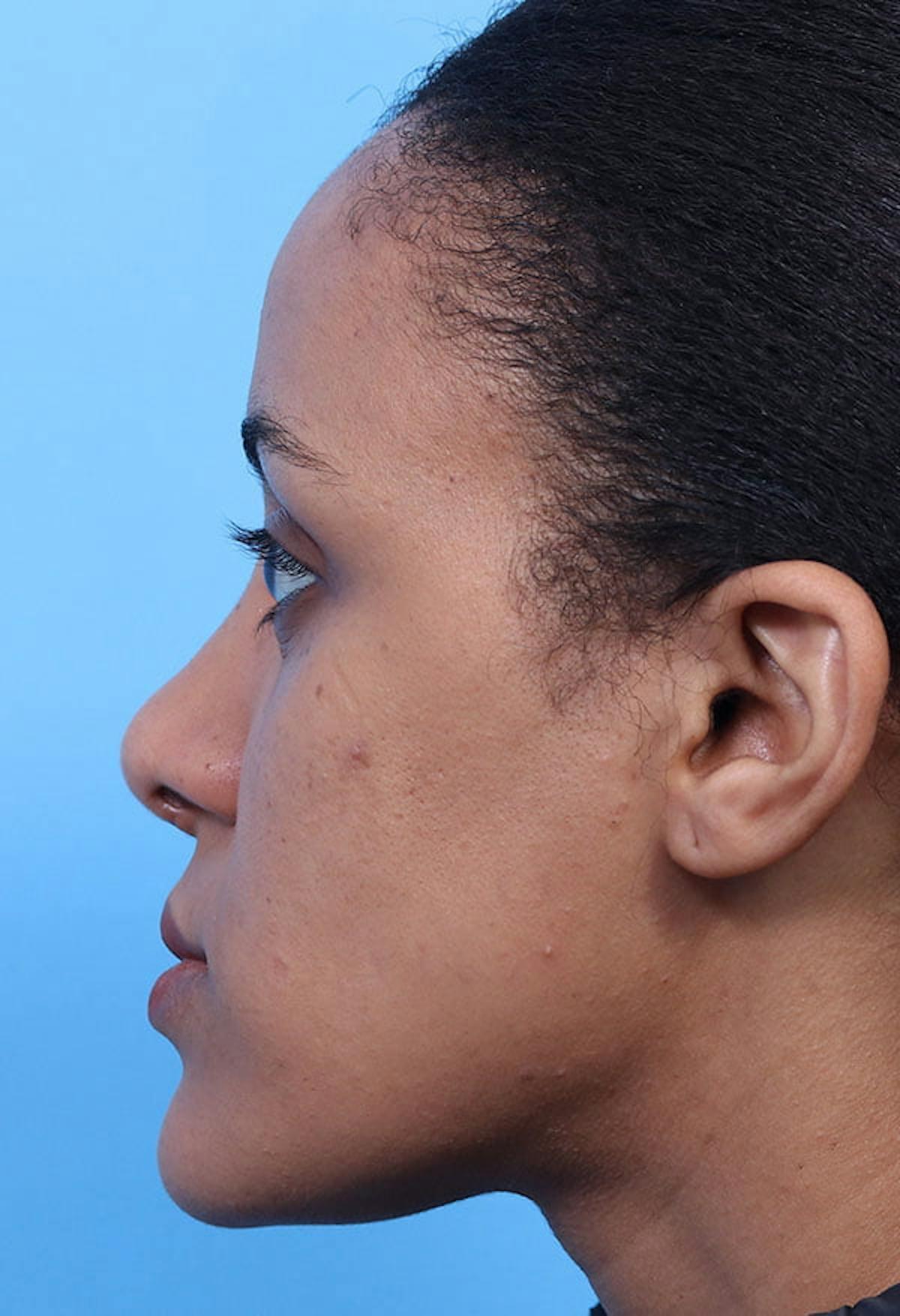 Basu Plastic Surgery rhinoplasty after — Houston, TX
