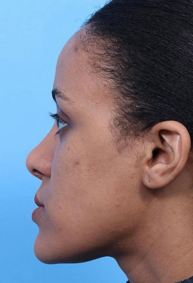 Liquid Rhinoplasty after at Basu Plastic Surgery in Houston, TX