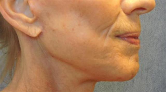 Neck Lift after at Basu Plastic Surgery in Houston, TX