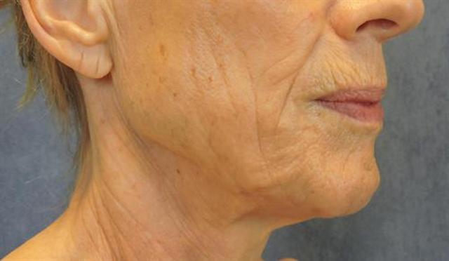 Neck Lift before at Basu Plastic Surgery in Houston, TX