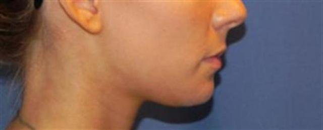 Chin Implant after at Basu Plastic Surgery in Houston, TX