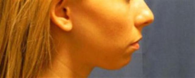 Chin Implant before at Basu Plastic Surgery in Houston, TX