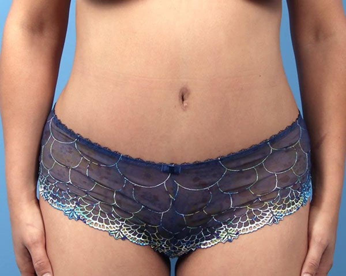 Basu Plastic Surgery tummy tuck after — Houston, TX
