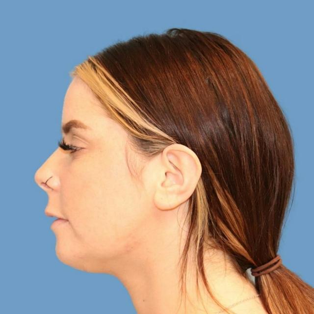 Chin Implant after at Basu Plastic Surgery in Houston, TX