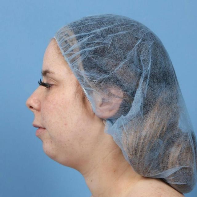 Chin Implant before at Basu Plastic Surgery in Houston, TX