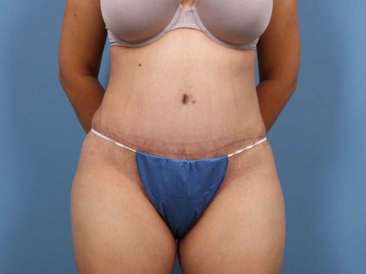 Basu Plastic Surgery tummy tuck after — Houston, TX