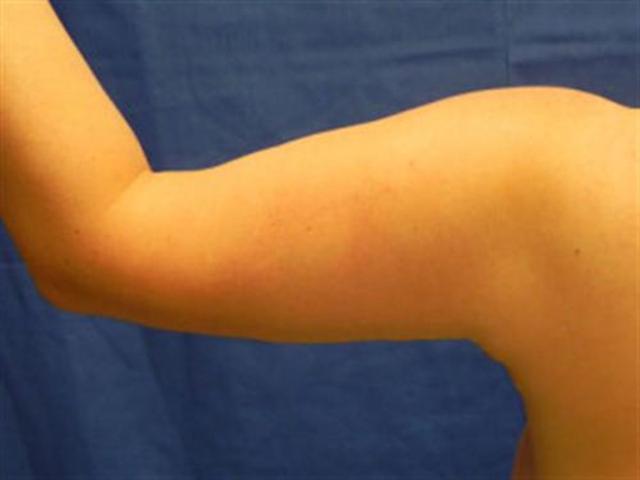 Arm Lift after at Basu Plastic Surgery in Houston, TX