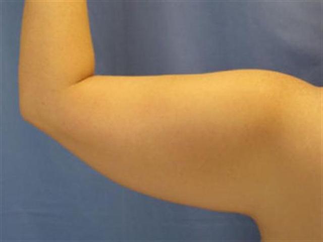 Arm Lift before at Basu Plastic Surgery in Houston, TX