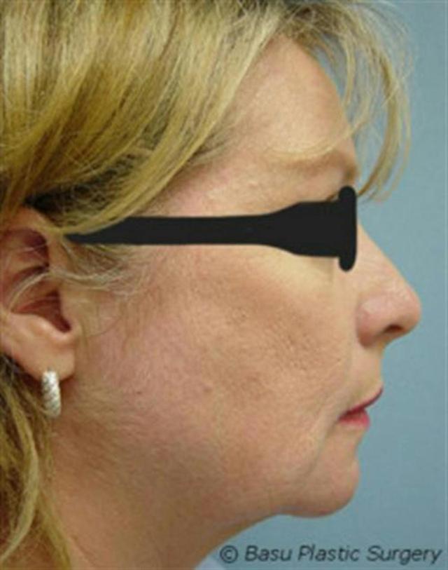 Chin Implant after at Basu Plastic Surgery in Houston, TX