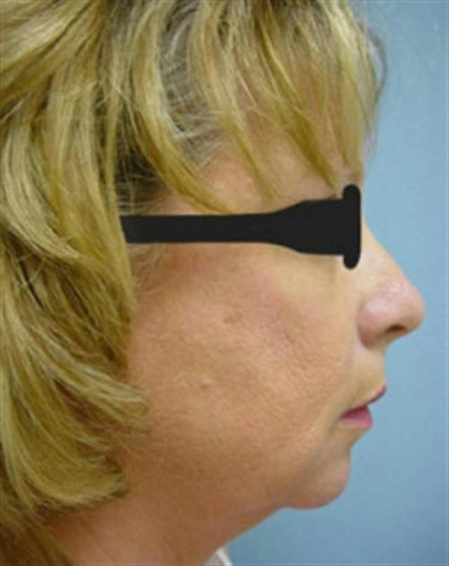 Chin Implant before at Basu Plastic Surgery in Houston, TX