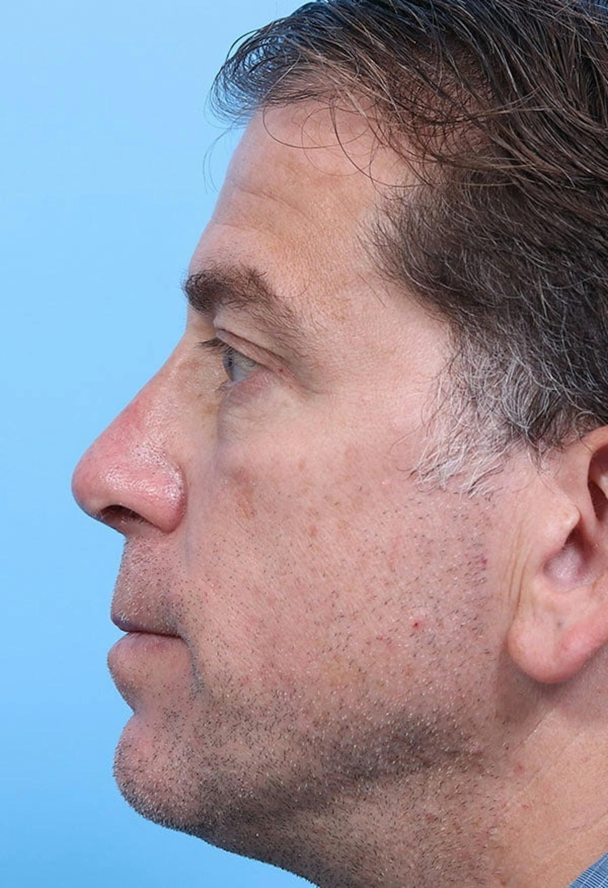 Basu Plastic Surgery rhinoplasty after — Houston, TX