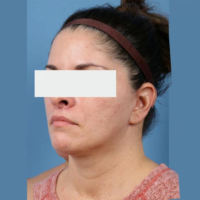 Neck Lift after at Basu Plastic Surgery in Houston, TX