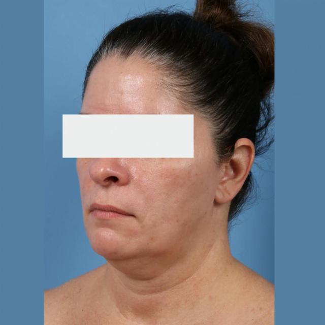 Neck Lift before at Basu Plastic Surgery in Houston, TX