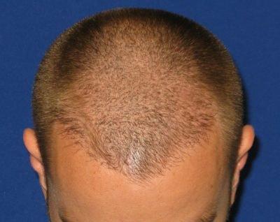 Rivela Plastic Surgery hair restoration after — The Woodlands, TX