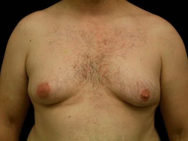 Gynecomastia Surgery before at Miguel Delgado, MD in San Francisco, CA