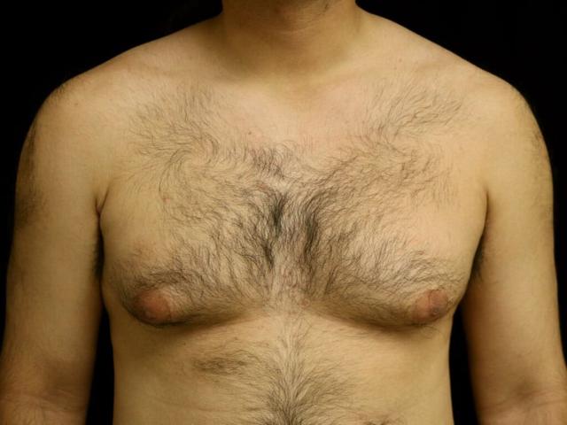 Gynecomastia Surgery before at Miguel Delgado, MD in San Francisco, CA