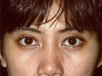 Miguel Delgado, MD eyelid lift after — San Francisco, CA