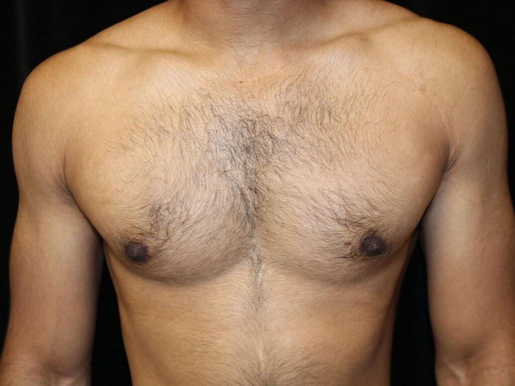 Miguel Delgado, MD gynecomastia after — San Francisco, CA