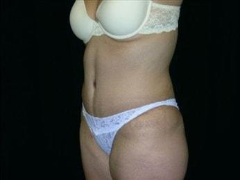 Mini Tummy Tuck after at Miguel Delgado, MD in San Francisco, CA