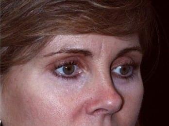 Miguel Delgado, MD eyelid lift after — San Francisco, CA