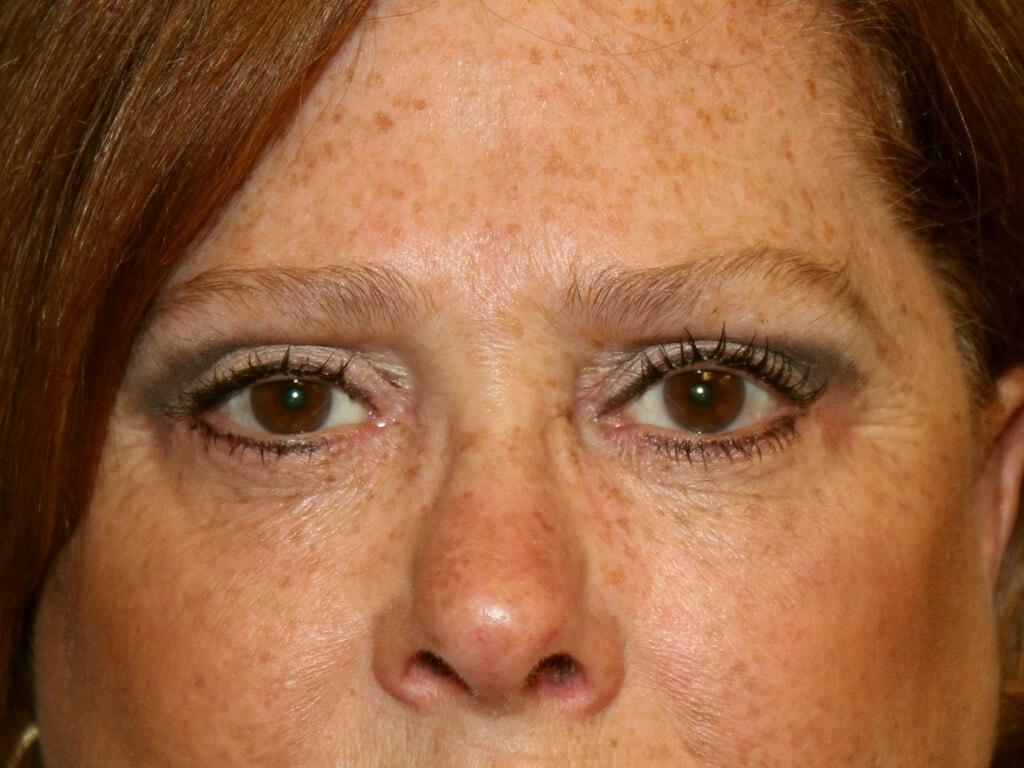 Miguel Delgado, MD eyelid lift after — San Francisco, CA