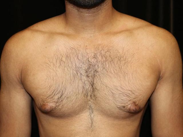 Gynecomastia Surgery before at Miguel Delgado, MD in San Francisco, CA
