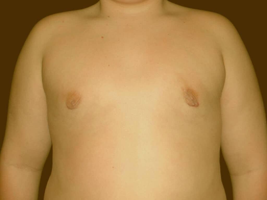 Miguel Delgado, MD gynecomastia after — San Francisco, CA