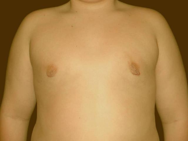 Gynecomastia Surgery after at Miguel Delgado, MD in San Francisco, CA