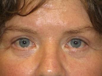 Miguel Delgado, MD eyelid lift after — San Francisco, CA