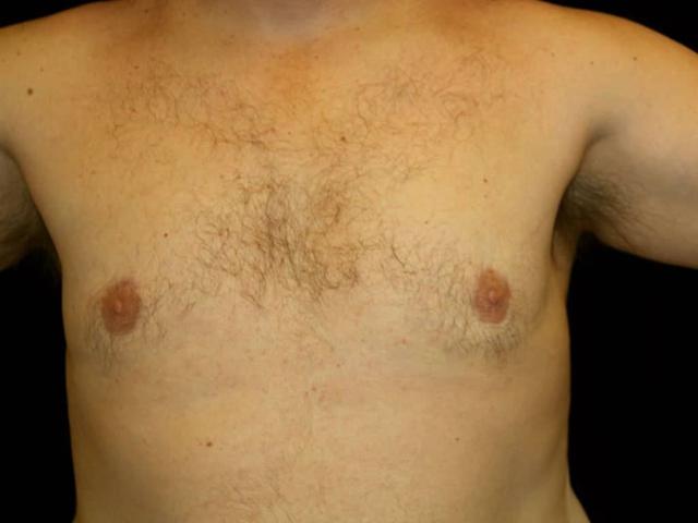 Gynecomastia Surgery after at Miguel Delgado, MD in San Francisco, CA