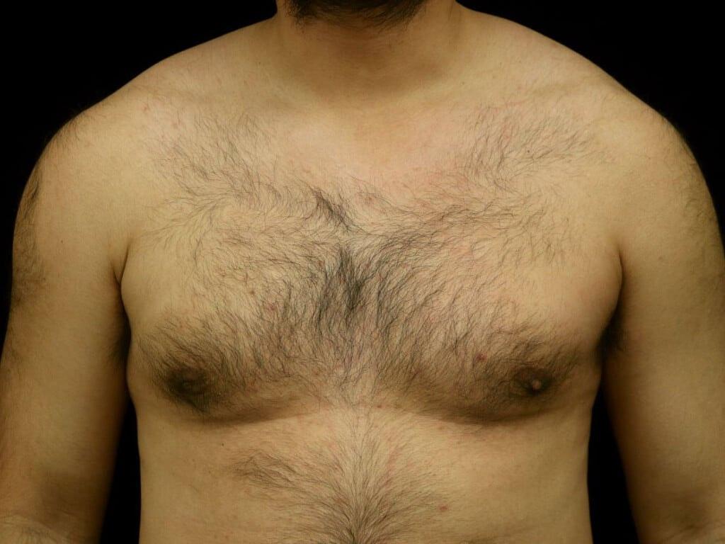 Miguel Delgado, MD gynecomastia after — San Francisco, CA