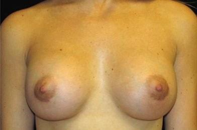 Breast Augmentation after at Miguel Delgado, MD in San Francisco, CA