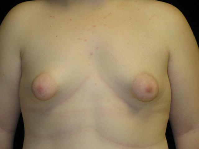 Breast Lift before at Miguel Delgado, MD in San Francisco, CA