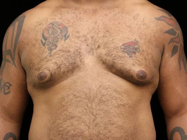 Gynecomastia Surgery before at Miguel Delgado, MD in San Francisco, CA