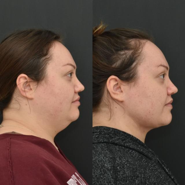 Neck Liposuction result at Coastline Plastic Surgery in Newport Beach, CA