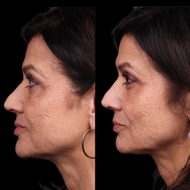 Dermal Fillers result at Coastline Plastic Surgery in Newport Beach, CA