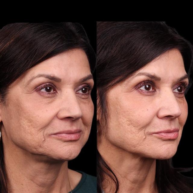 Dermal Fillers result at Coastline Plastic Surgery in Newport Beach, CA
