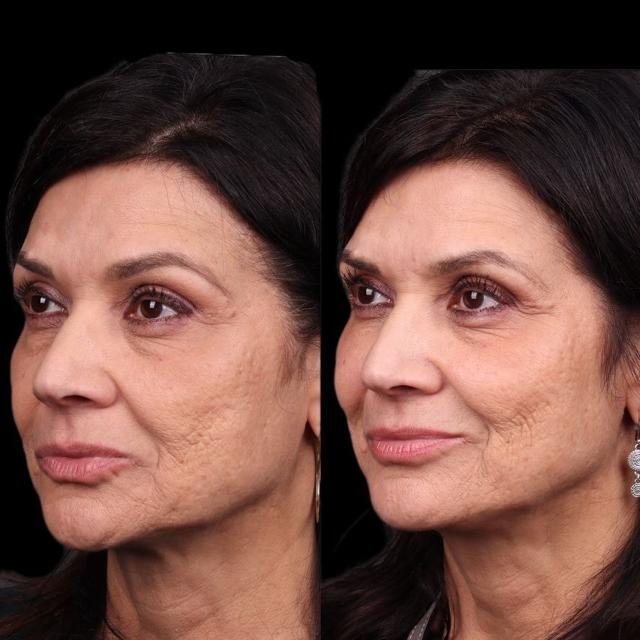 Dermal Fillers result at Coastline Plastic Surgery in Newport Beach, CA