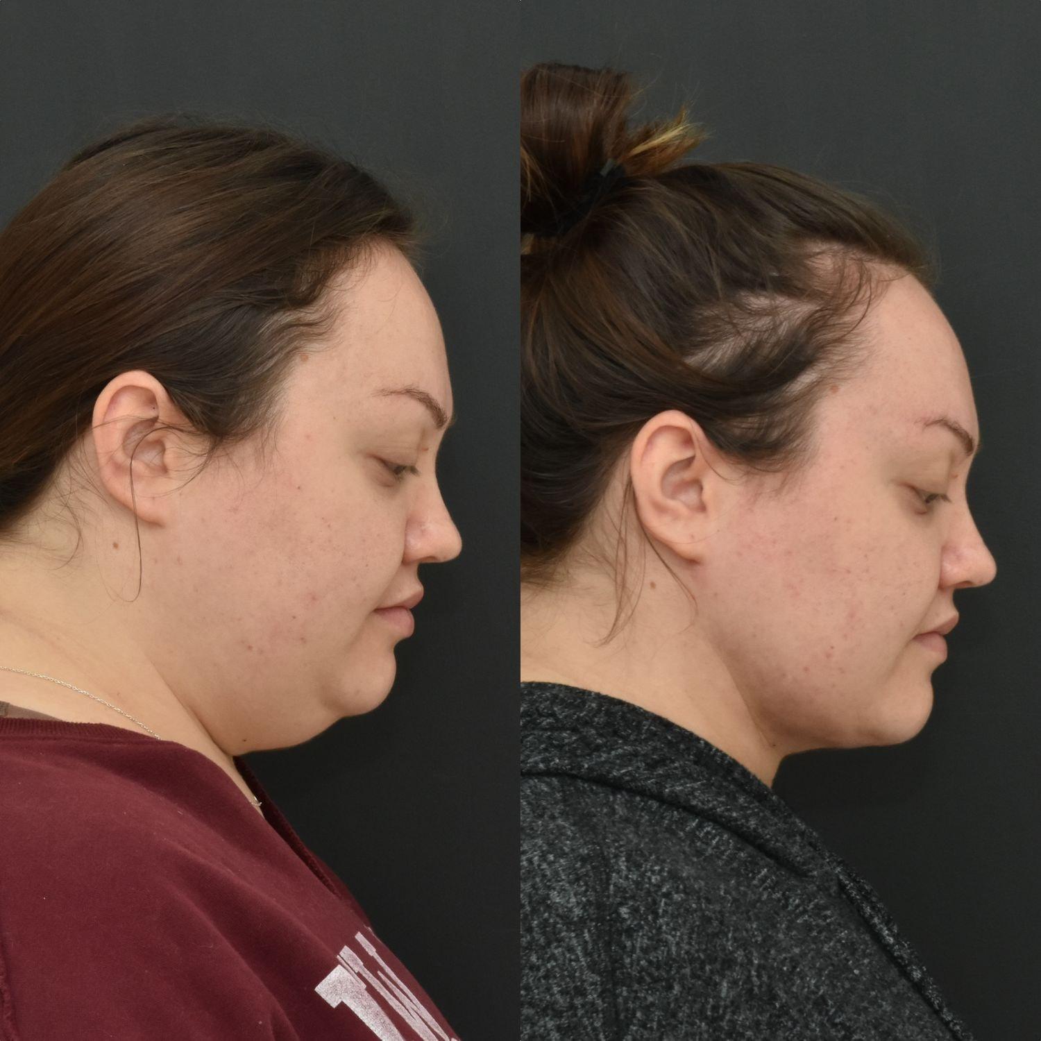 Coastline Plastic Surgery submental liposuction result — Newport Beach, CA