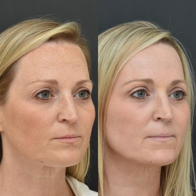 Laser Skin Resurfacing result at Coastline Plastic Surgery in Newport Beach, CA