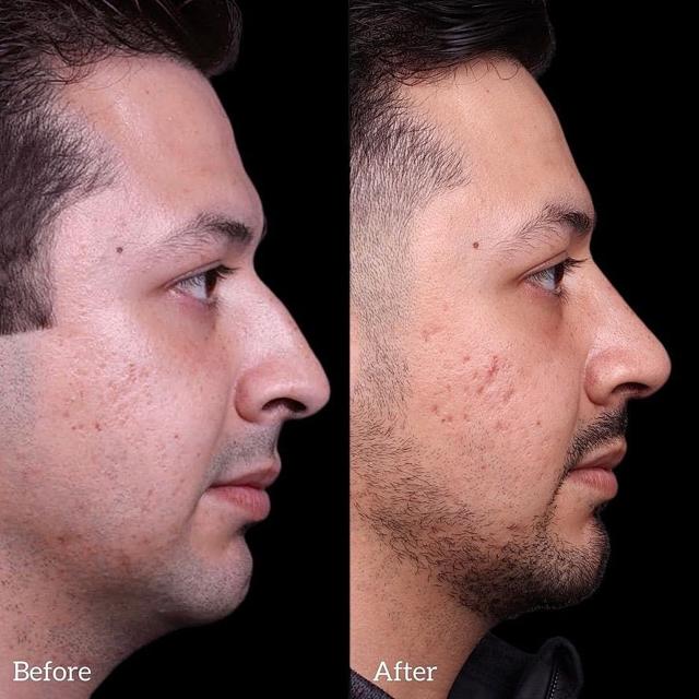 Rhinoplasty result at Coastline Plastic Surgery in Newport Beach, CA