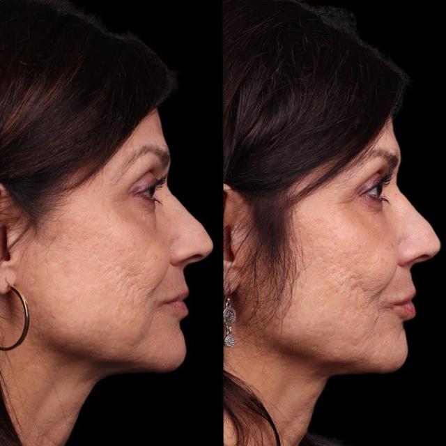 Dermal Fillers result at Coastline Plastic Surgery in Newport Beach, CA