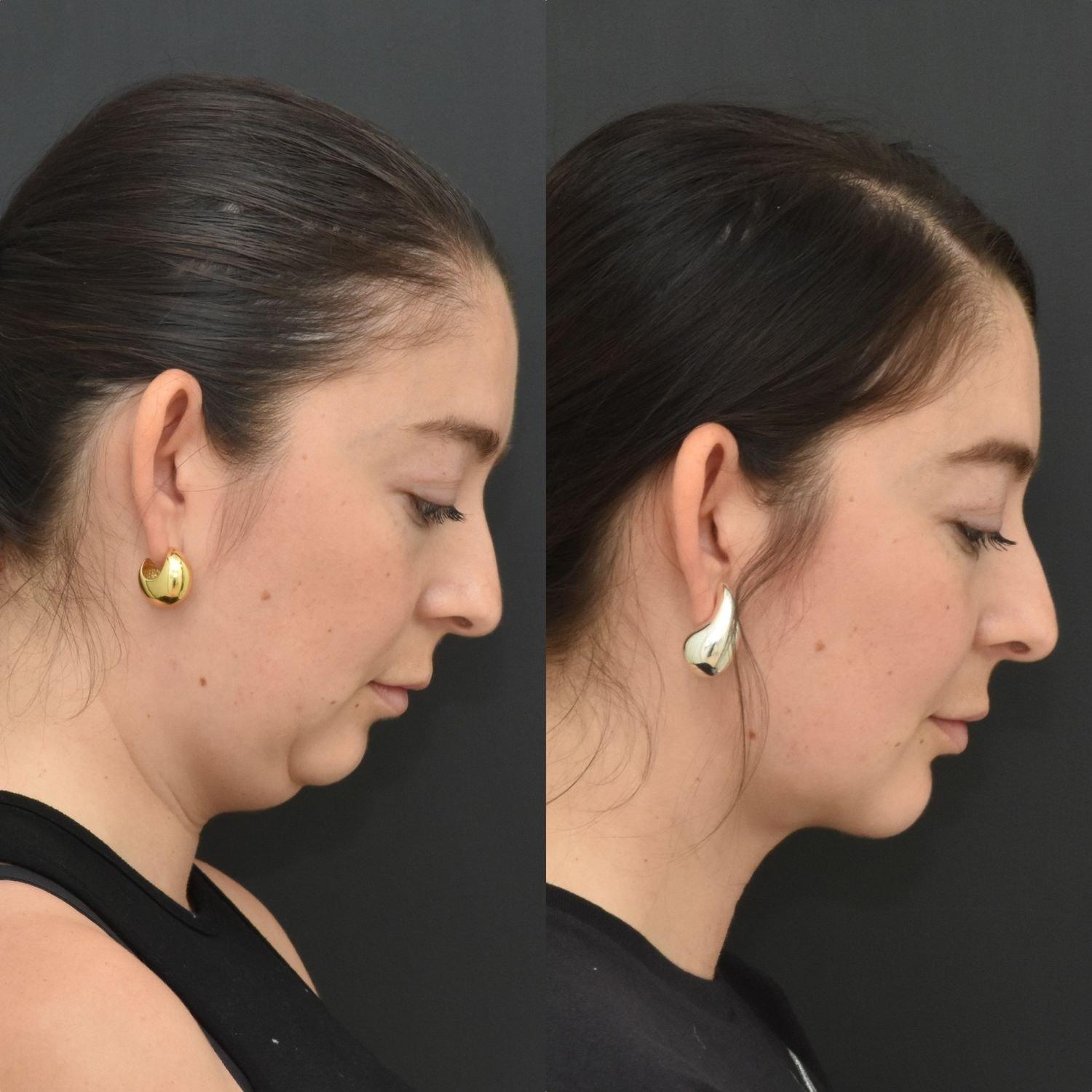 Coastline Plastic Surgery submental liposuction result — Newport Beach, CA