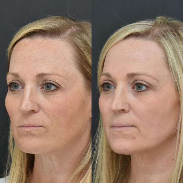 Laser Skin Resurfacing result at Coastline Plastic Surgery in Newport Beach, CA