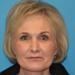 Utah Facial Surgical Arts lip lift after — Salt Lake City, UT