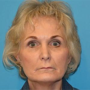 Deep Plane Facelift before at Utah Facial Surgical Arts in West Jordan, UT