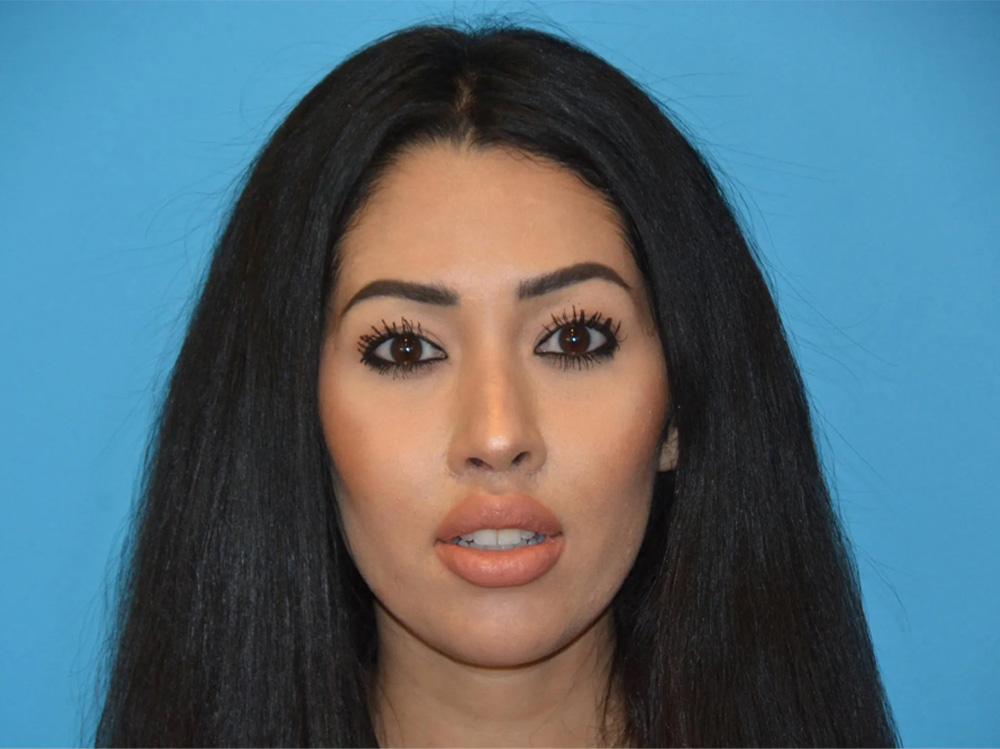 Utah Facial Surgical Arts lip lift after — West Jordan, UT